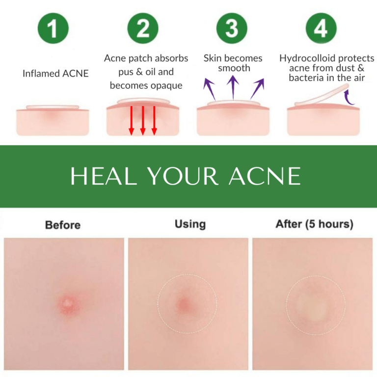 4 steps to heal acne with the acne patch in 5 hours