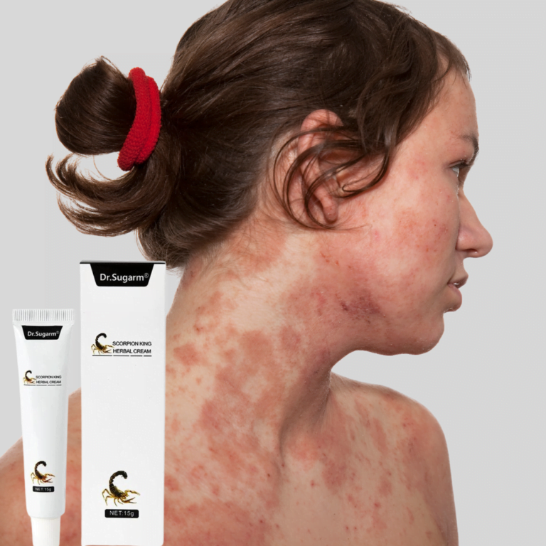 Skin Inflammation Relief Cream for Psoriasis, Eczema, and Dermatitis for irritated skin conditions