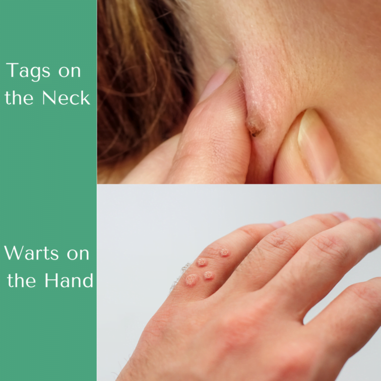 Remove skin tags and warts from the neck and hands in 2 weeks
