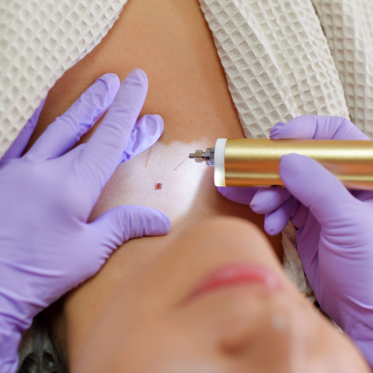 no need for costly skin tag and moles laser surgery