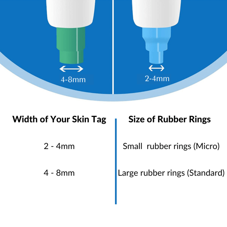 Skin tag removal kit for large and small skin tags and moles