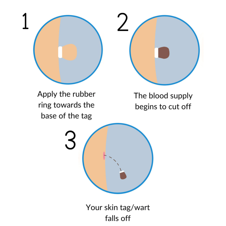 How to use the skin tag removal kit on your moles, warts, and skin tags