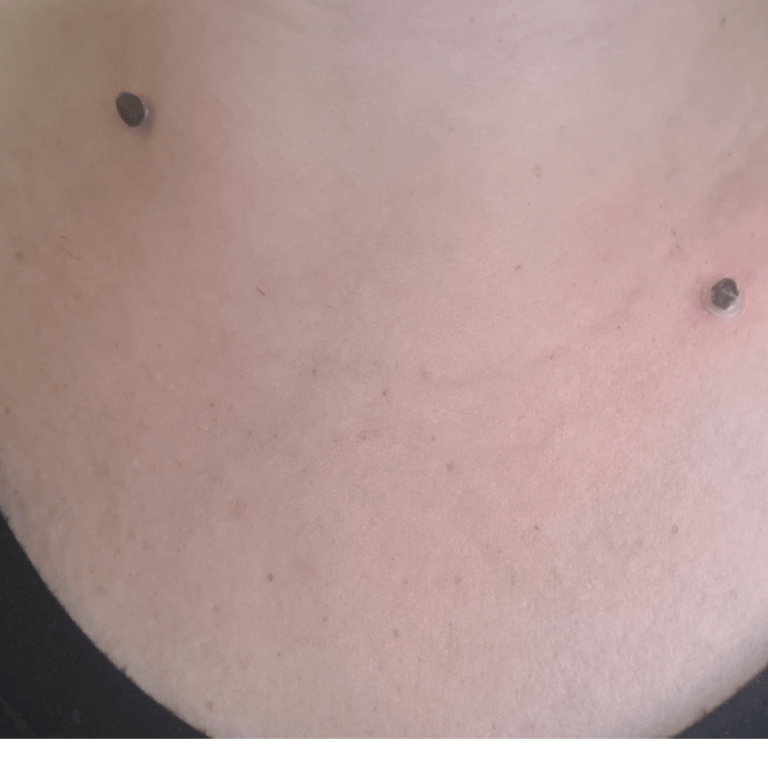 skin tag removal kit is transparent to wear on the go