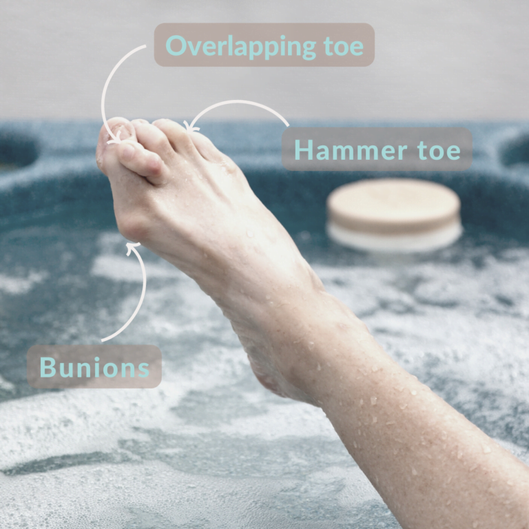 Fix bunions, hammer toes, overlapping toes easy with the Bunion and Toe Corrector