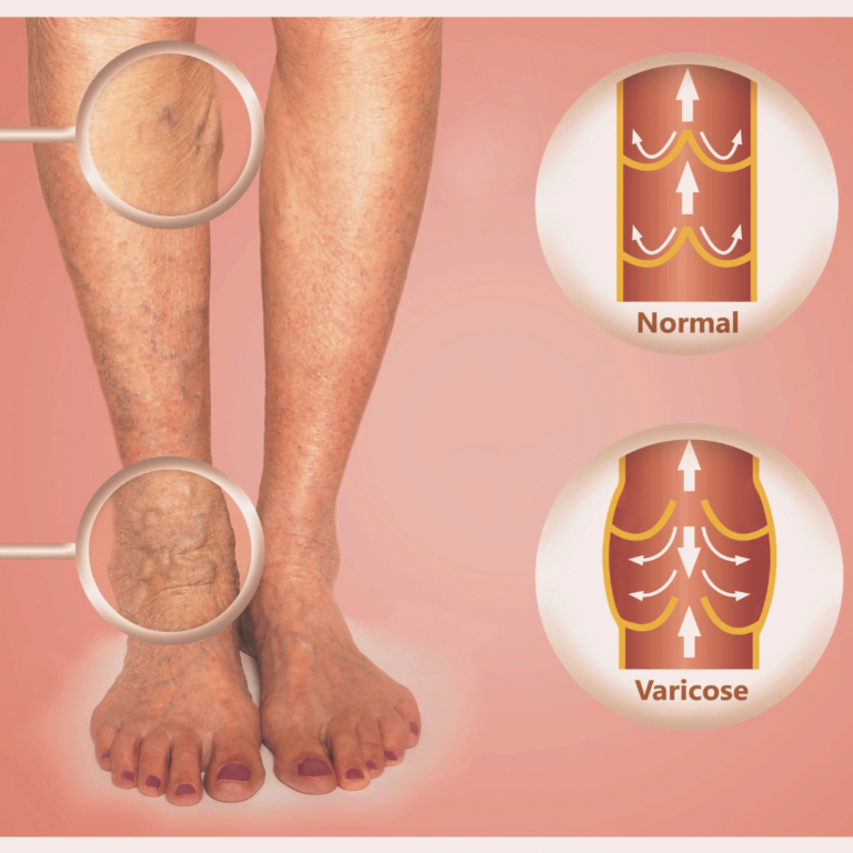 Varicose and Spider Vein Removal Cream- reduce bulging veins