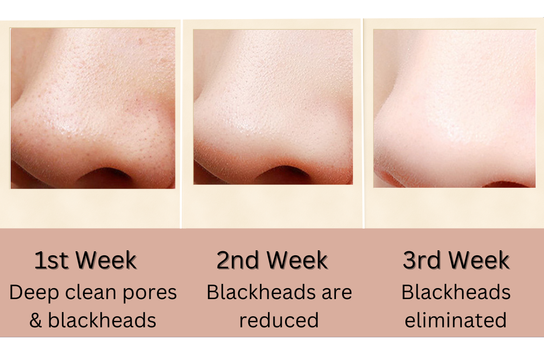 Pore Perfector Pro Blackhead Remover and Hydrating Mist 2 e1720838422211 2025